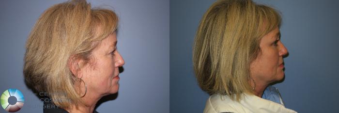 Before & After Mini Brow Lift Case 11458 Right Side View in Golden, CO