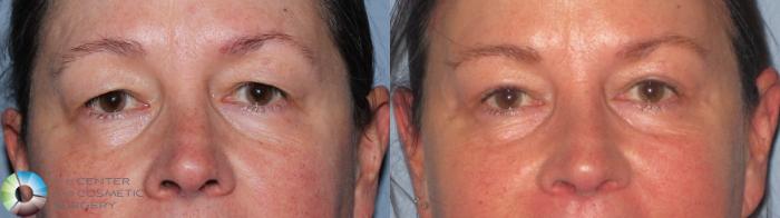 Before & After Mini Brow Lift Case 11491 Front View in Golden, CO