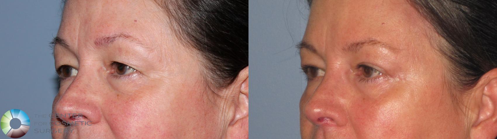 Before & After Mini Brow Lift Case 11491 Left Oblique View in Golden, CO