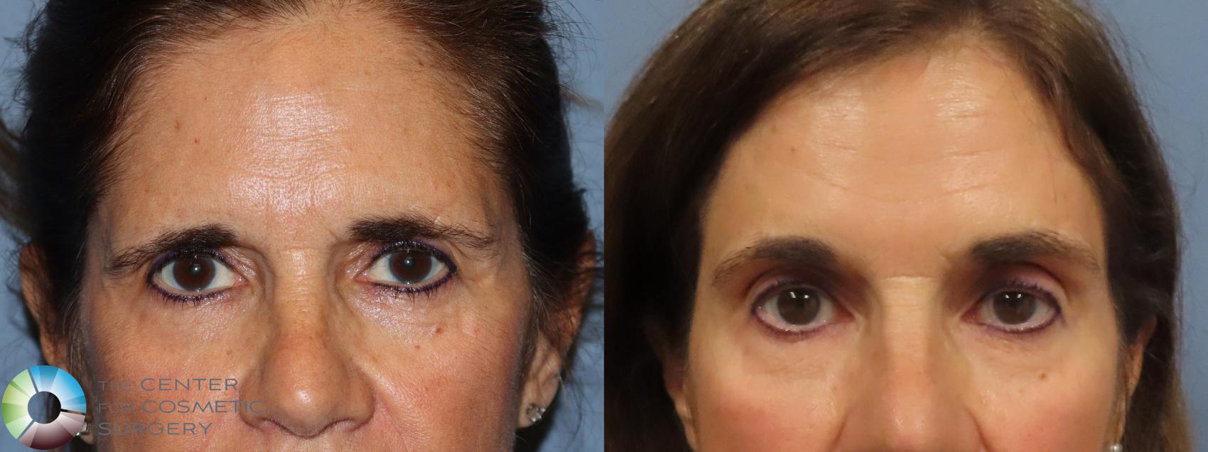 Before & After Mini Brow Lift Case 11871 Front in Denver and Colorado Springs, CO