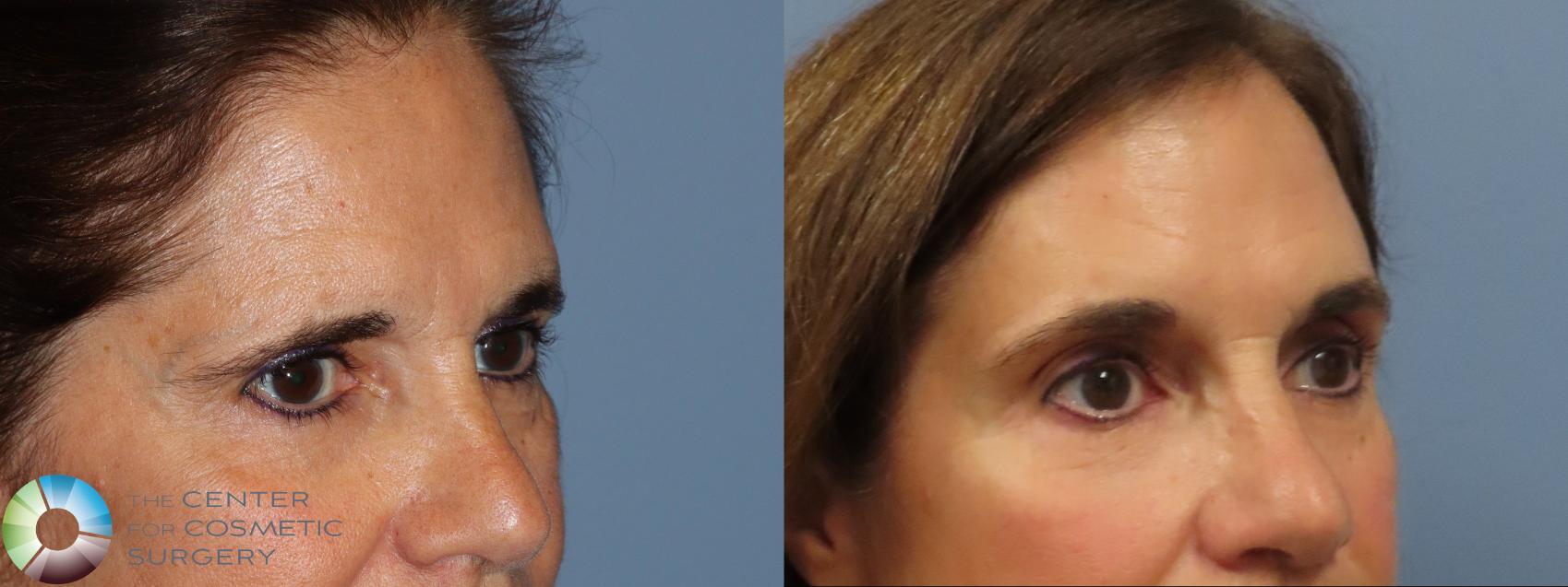 Before & After Mini Brow Lift Case 11871 Right Oblique in Denver and Colorado Springs, CO