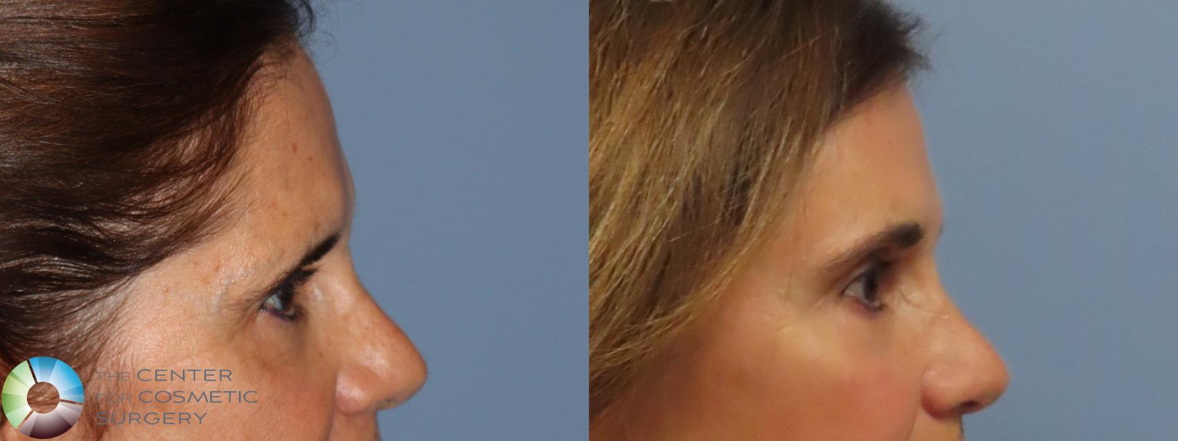 Before & After Mini Brow Lift Case 11871 Right Side in Denver and Colorado Springs, CO