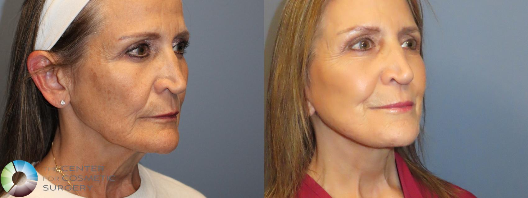 Before & After Mini Brow Lift Case 11987 Right Oblique in Denver and Colorado Springs, CO