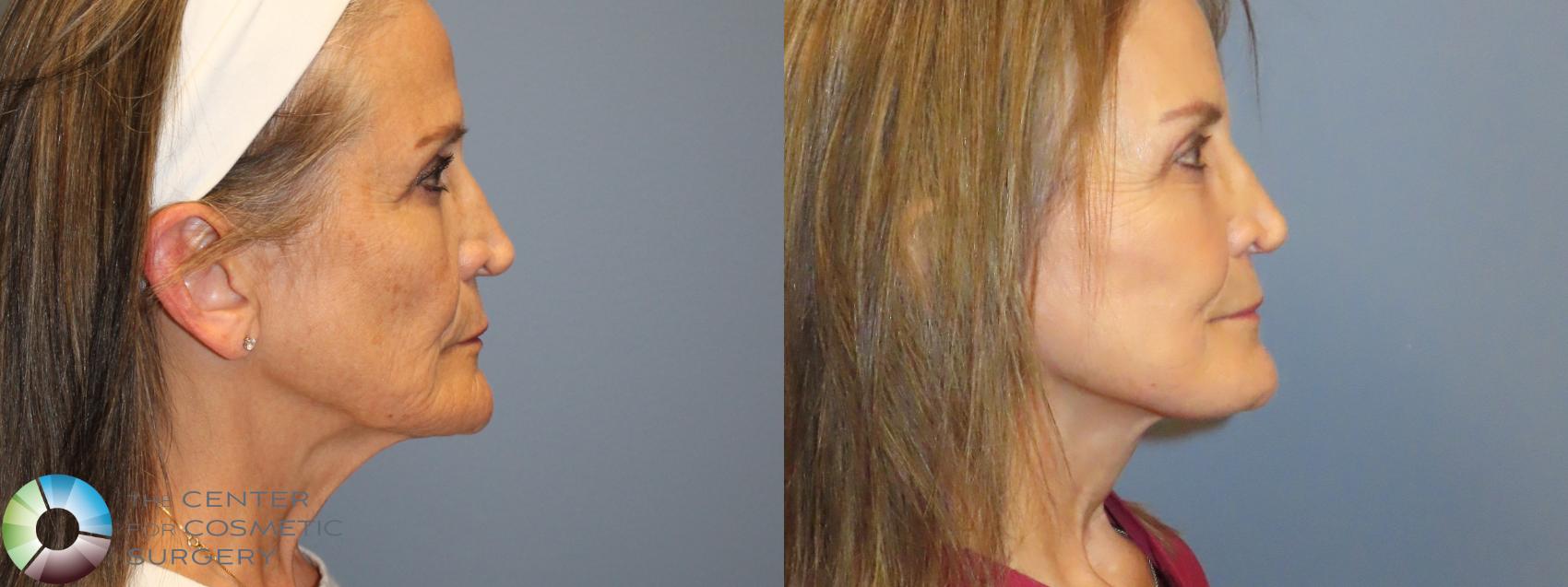 Before & After Mini Brow Lift Case 11987 Right Side in Denver and Colorado Springs, CO