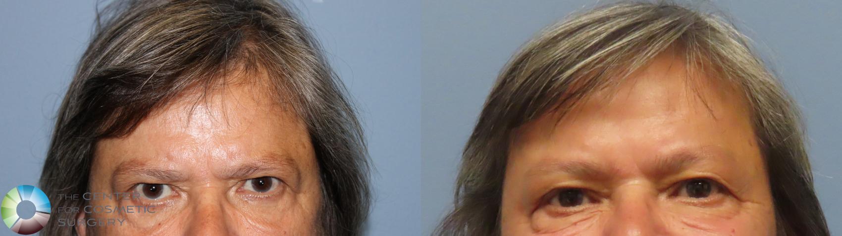 Before & After Mini Brow Lift Case 11997 Front in Denver and Colorado Springs, CO