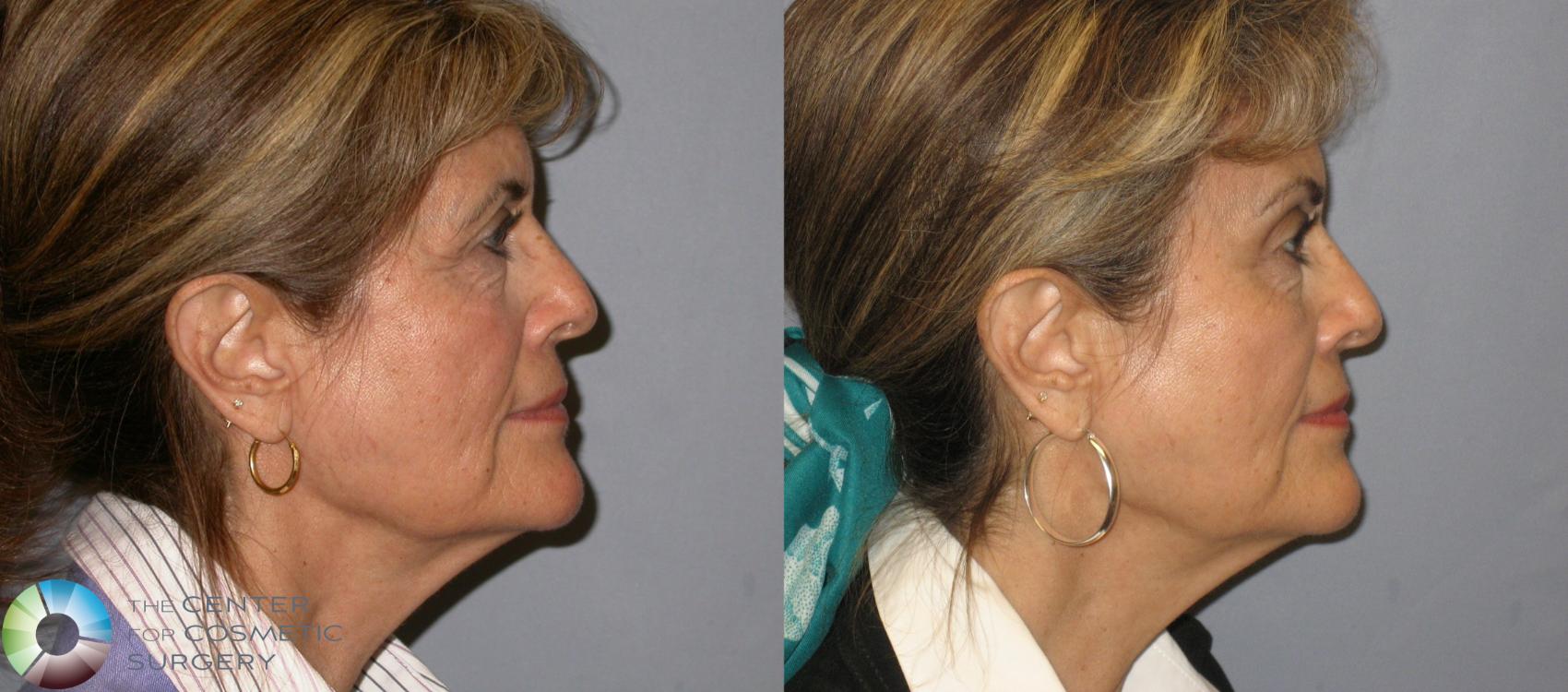 Before & After Mini Brow Lift Case 120 View #3 View in Golden, CO