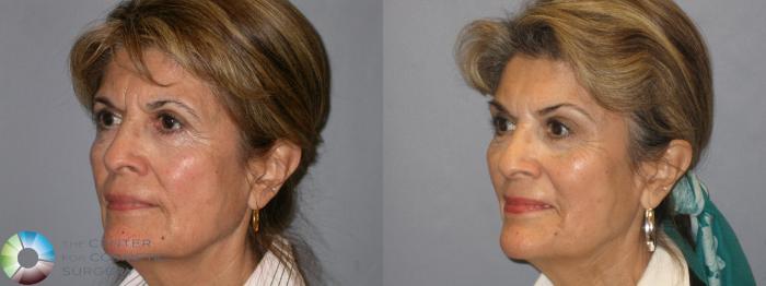 Before & After Mini Brow Lift Case 120 View #4 in Denver and Colorado Springs, CO
