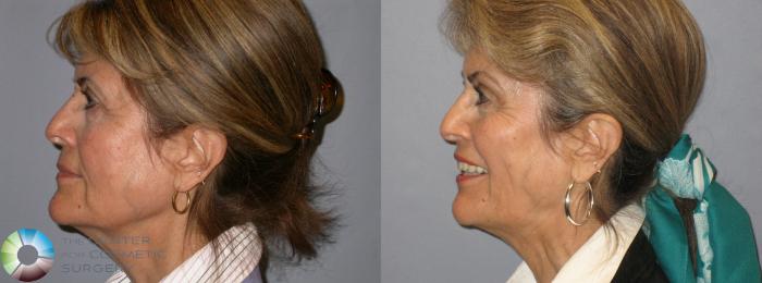Before & After Mini Brow Lift Case 120 View #5 in Denver and Colorado Springs, CO