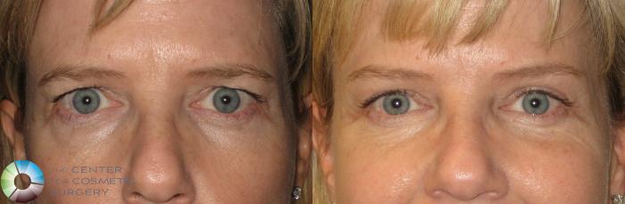 Before & After Mini Brow Lift Case 154 View #1 View in Golden, CO