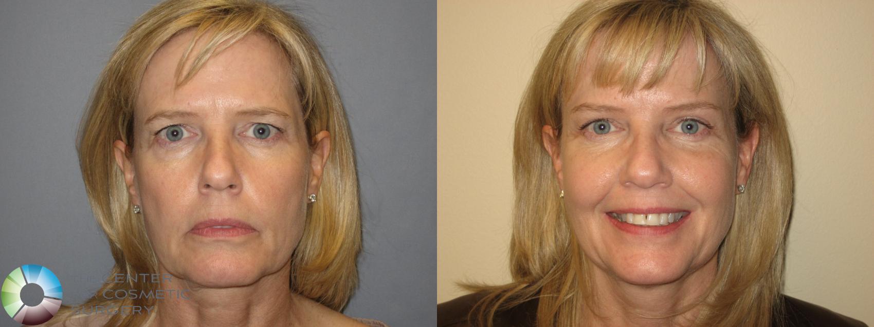 Before & After Mini Brow Lift Case 154 View #2 View in Golden, CO