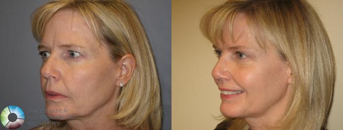 Before & After Eyelid Lift Case 154 View #3 View in Golden, CO
