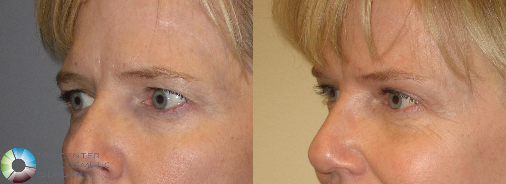 Before & After Mini Brow Lift Case 154 View #4 View in Golden, CO