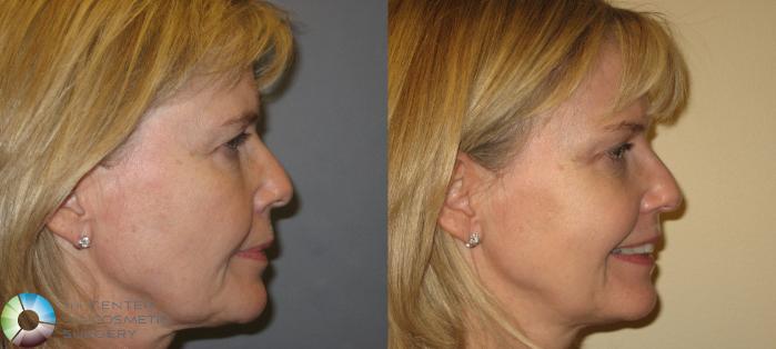 Before & After Mini Brow Lift Case 154 View #5 View in Golden, CO