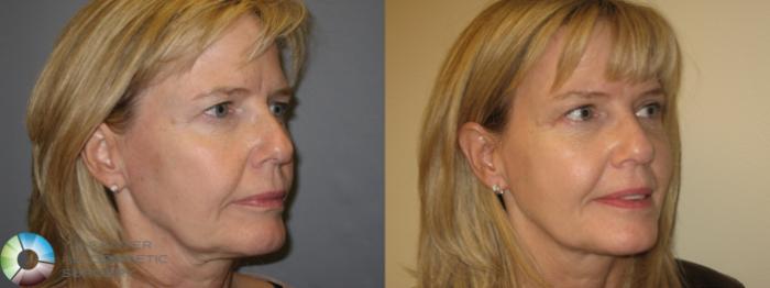 Before & After Mini Brow Lift Case 154 View #6 View in Golden, CO