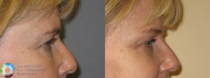 Before & After Mini Brow Lift Case 154 View #7 View in Golden, CO