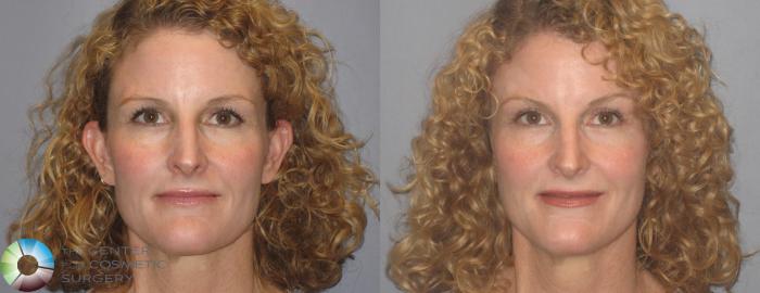 Before & After Mini Brow Lift Case 251 View #1 View in Golden, CO