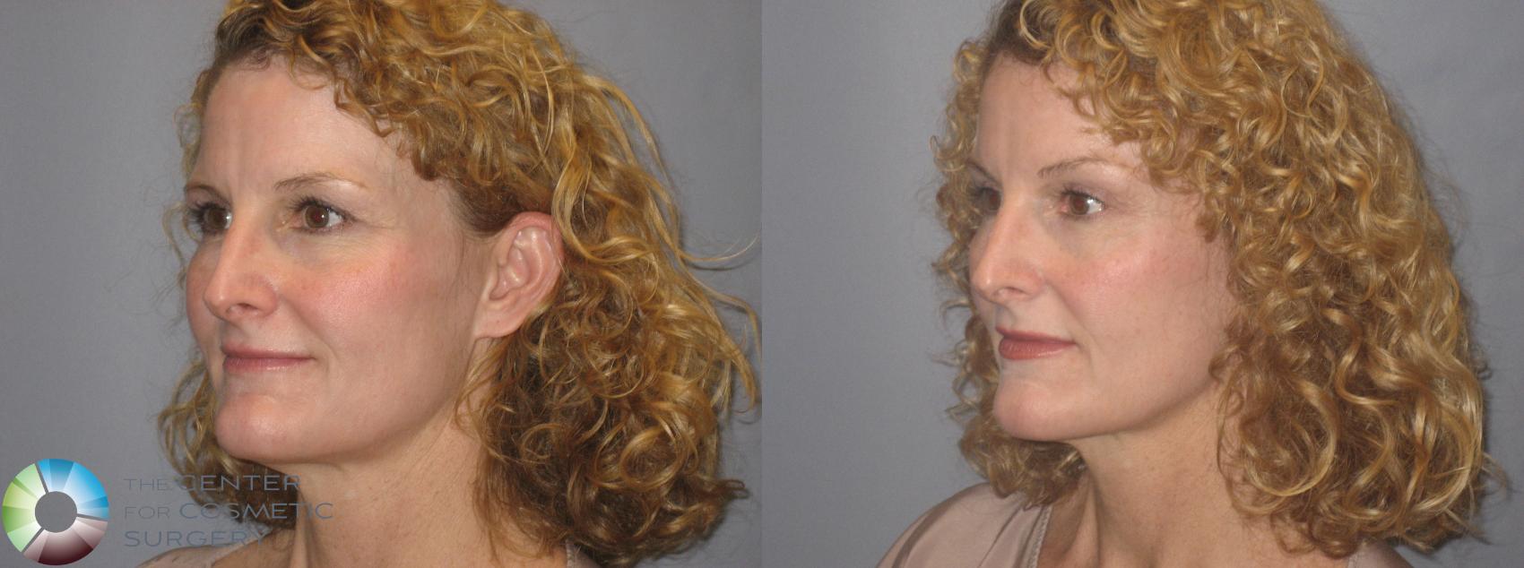 Before & After Mini Brow Lift Case 251 View #3 View in Golden, CO