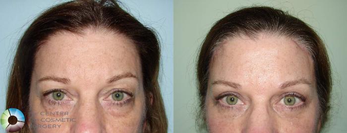 Before & After Mini Brow Lift Case 505 View #1 View in Golden, CO
