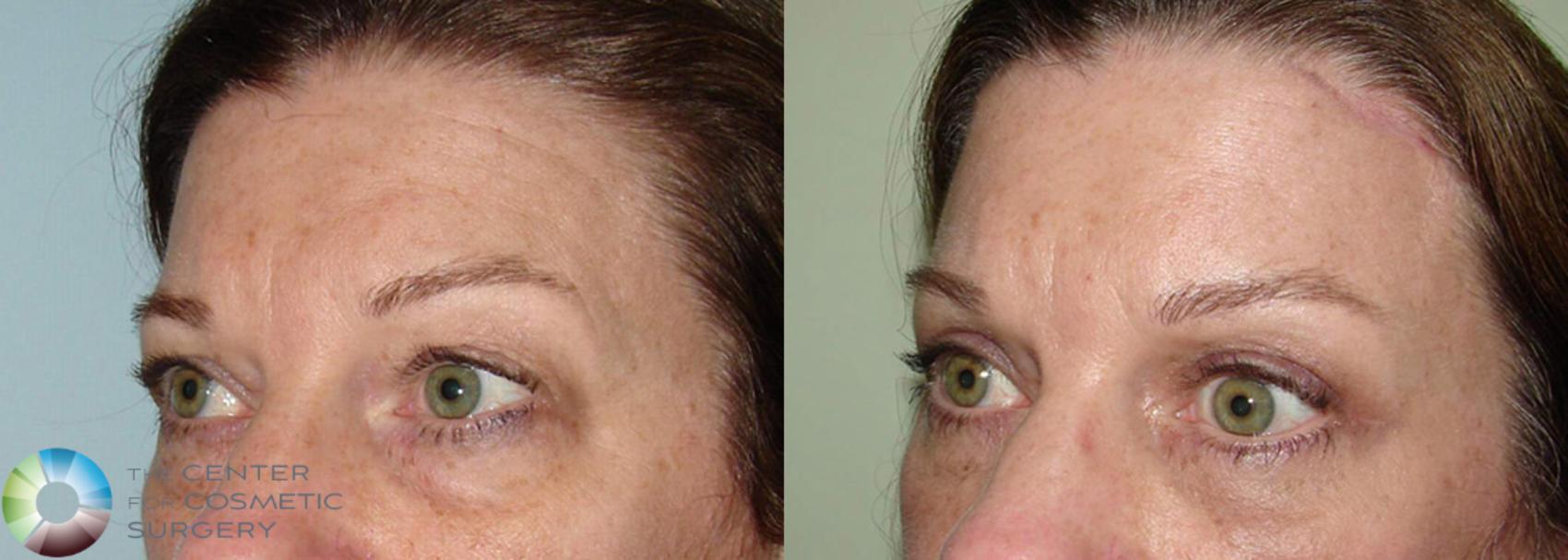 Before & After Mini Brow Lift Case 505 View #2 in Denver and Colorado Springs, CO