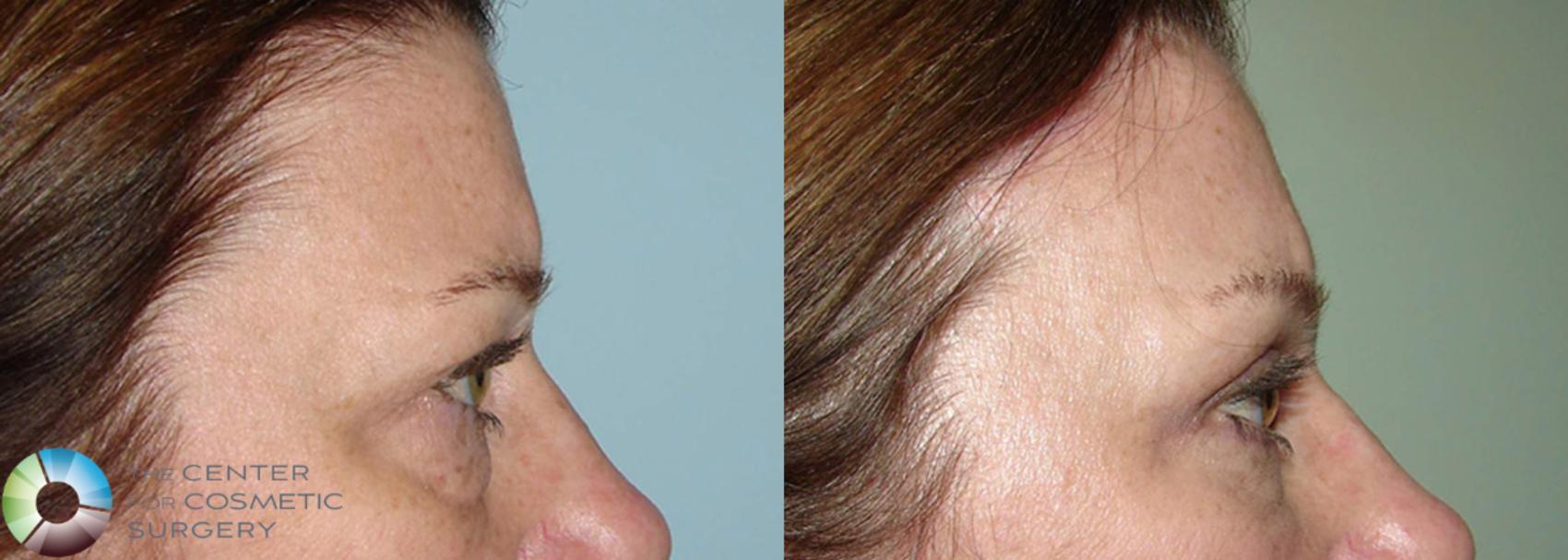 Before & After Mini Brow Lift Case 505 View #3 in Denver and Colorado Springs, CO