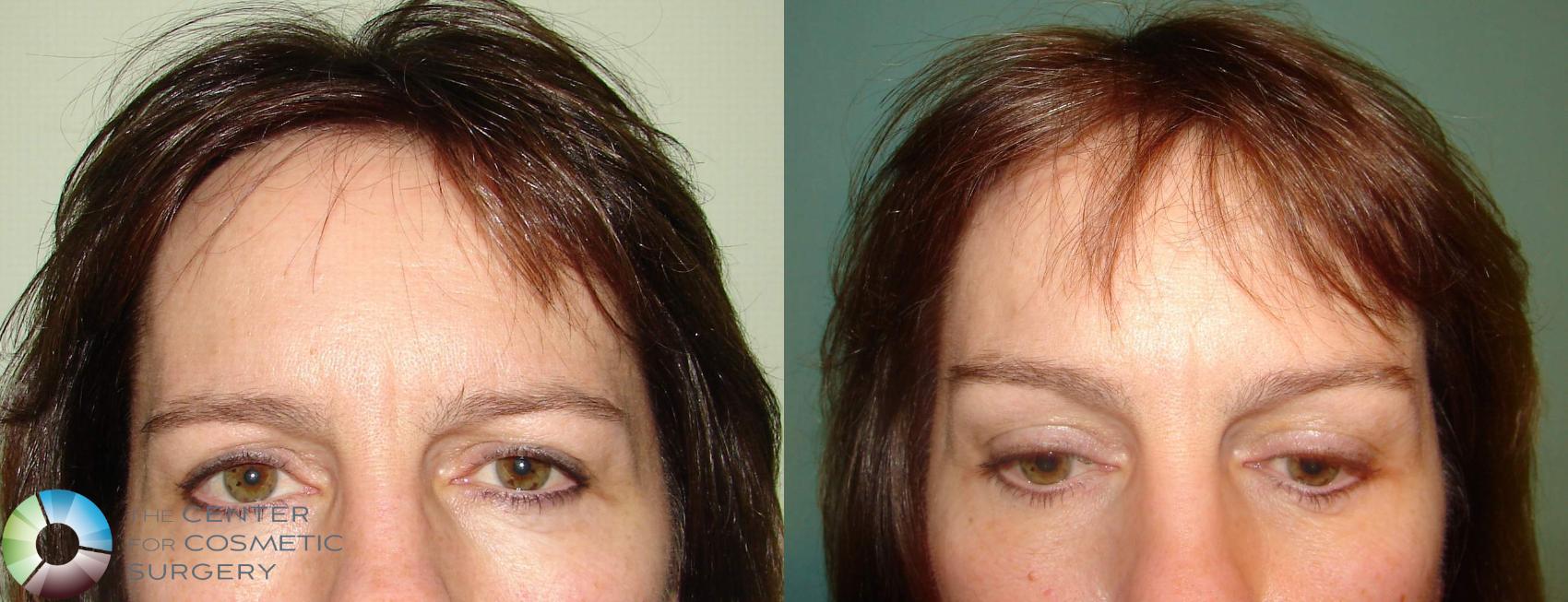 Before & After Mini Brow Lift Case 636 View #1 in Denver and Colorado Springs, CO