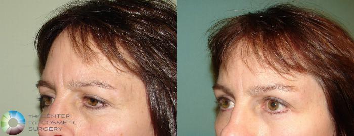 Before & After Mini Brow Lift Case 636 View #2 View in Golden, CO