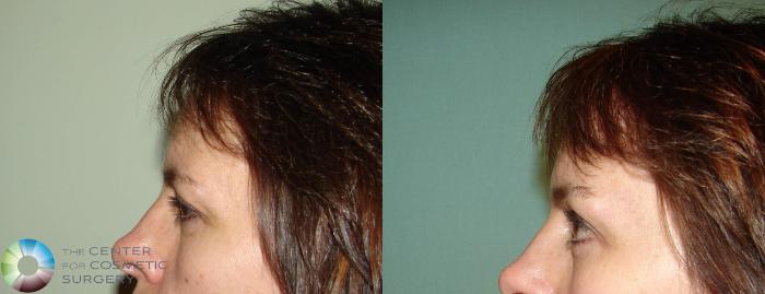 Before & After Mini Brow Lift Case 636 View #3 View in Golden, CO