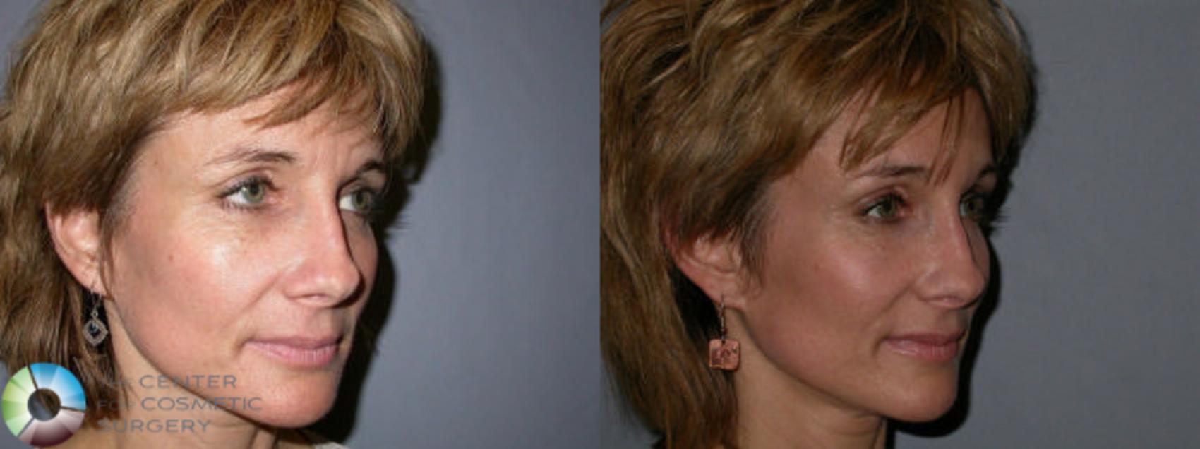 Before & After Mini Brow Lift Case 67 View #1 in Denver and Colorado Springs, CO