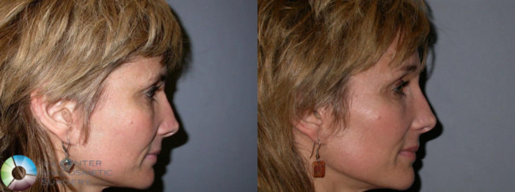 Before & After Mini Brow Lift Case 67 View #2 in Denver and Colorado Springs, CO