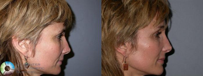 Before & After Mini Brow Lift Case 67 View #2 View in Golden, CO