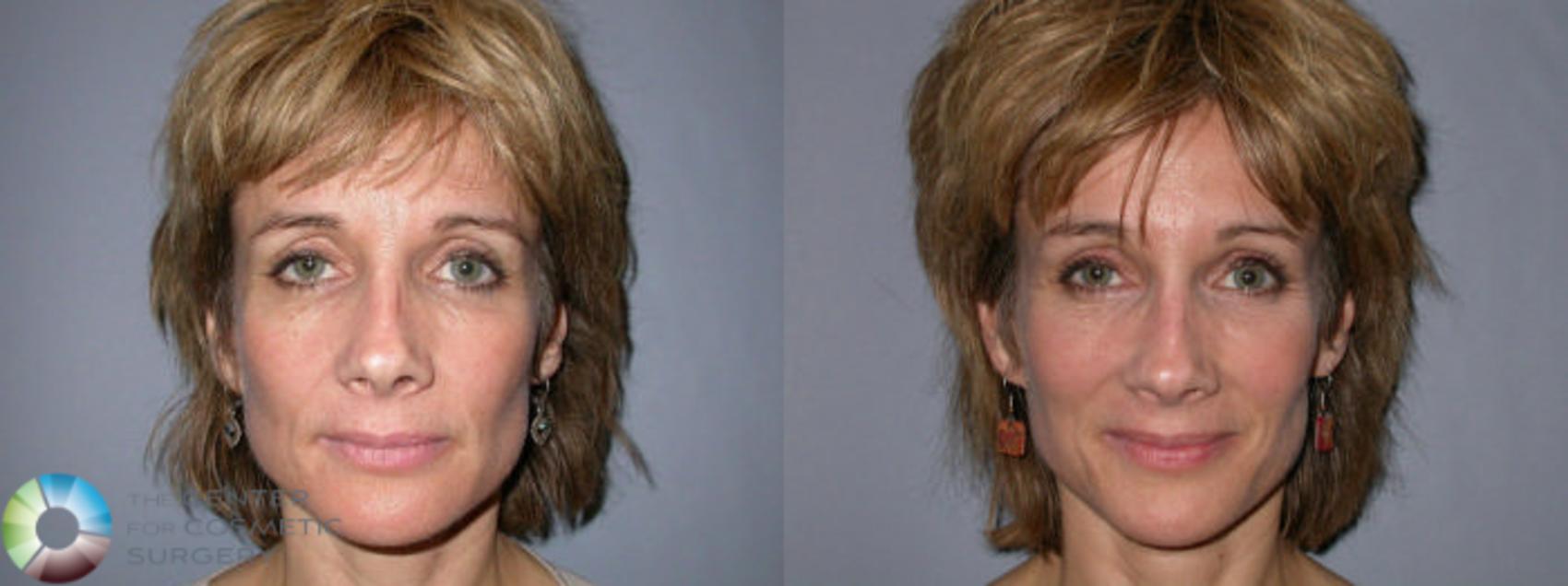 Before & After Mini Brow Lift Case 67 View #3 in Denver and Colorado Springs, CO