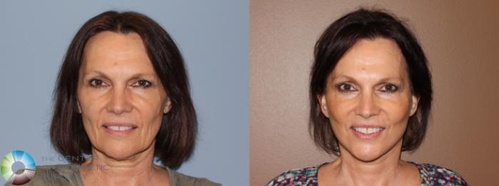 Before & After Mini Brow Lift Case 708 View #1 View in Golden, CO