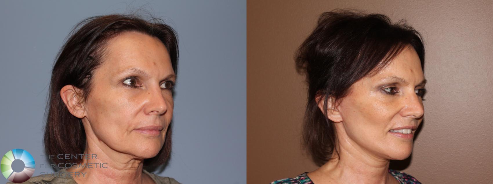 Before & After Mini Brow Lift Case 708 View #2 View in Golden, CO