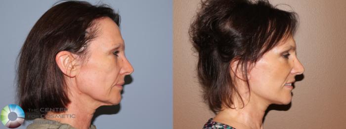 Before & After Eyelid Lift Case 708 View #3 View in Golden, CO