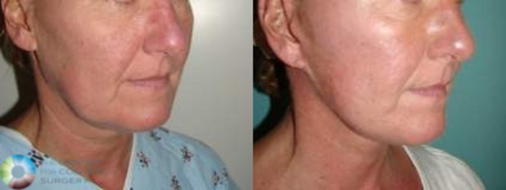 Before & After Mini Facelift Case 10868 view-1 in Denver and Colorado Springs, CO