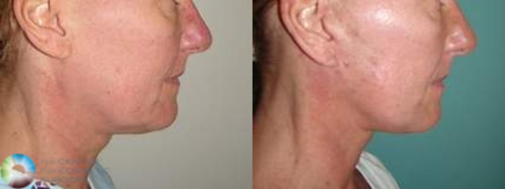 Before & After Mini Facelift Case 10868 view-2 in Denver and Colorado Springs, CO