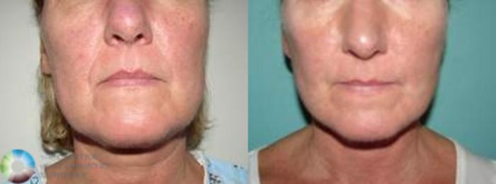 Best Denver Mini-Facelift/Neck Lift