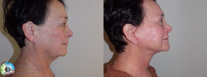 Before & After Mini Facelift Case 11008 Right Lateral in Denver, CO