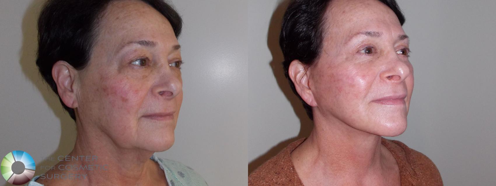 Before & After Mini Facelift Case 11008 Right Oblique in Denver, CO