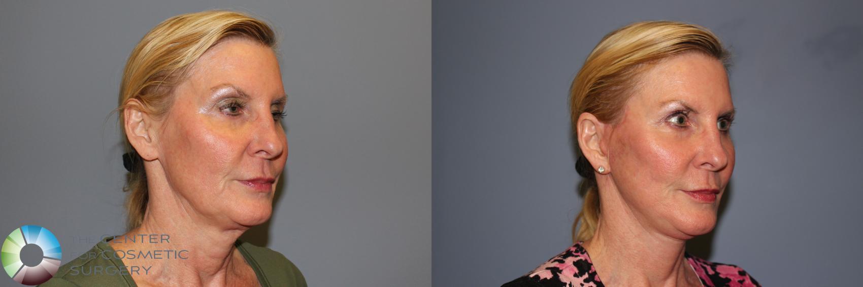 Before & After Mini Facelift Case 11241 Right Oblique in Denver and Colorado Springs, CO