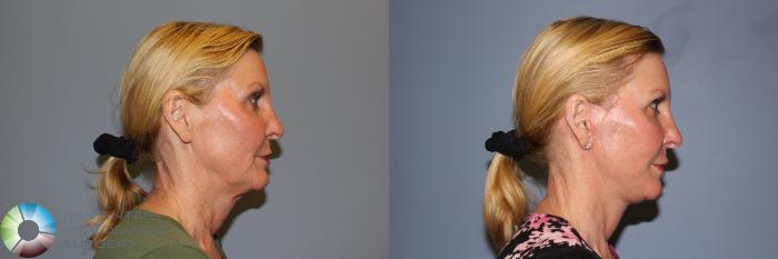 Before & After Mini Facelift Case 11241 Right Side View in Golden, CO