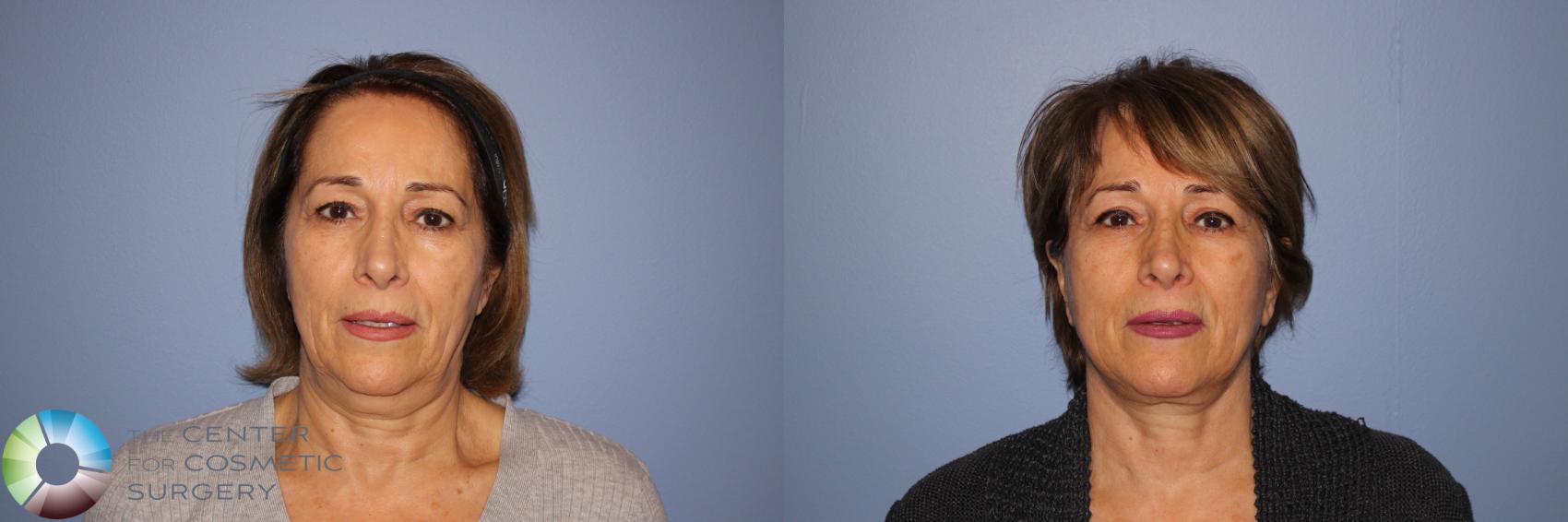 Before & After Mini Facelift Case 11246 Front in Denver and Colorado Springs, CO