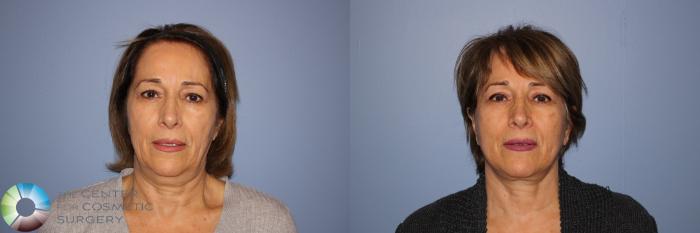 Before & After Mini Facelift Case 11246 Front View in Golden, CO
