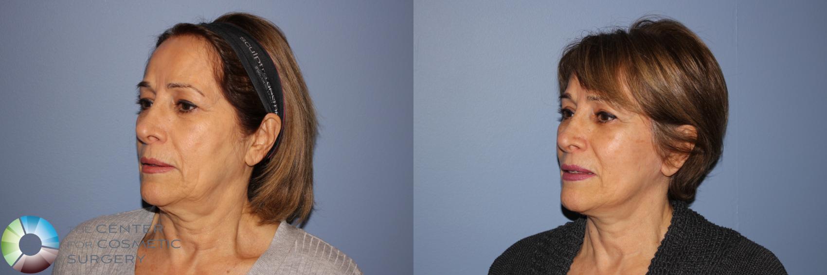 Before & After Mini Facelift Case 11246 Left Oblique View in Golden, CO