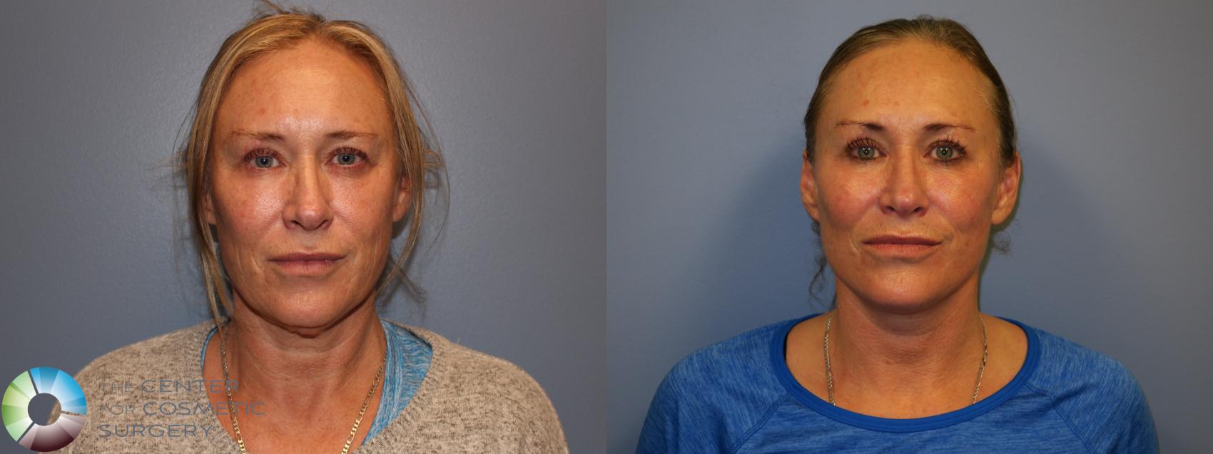 Before & After Mini Facelift Case 11293 Front View in Golden, CO