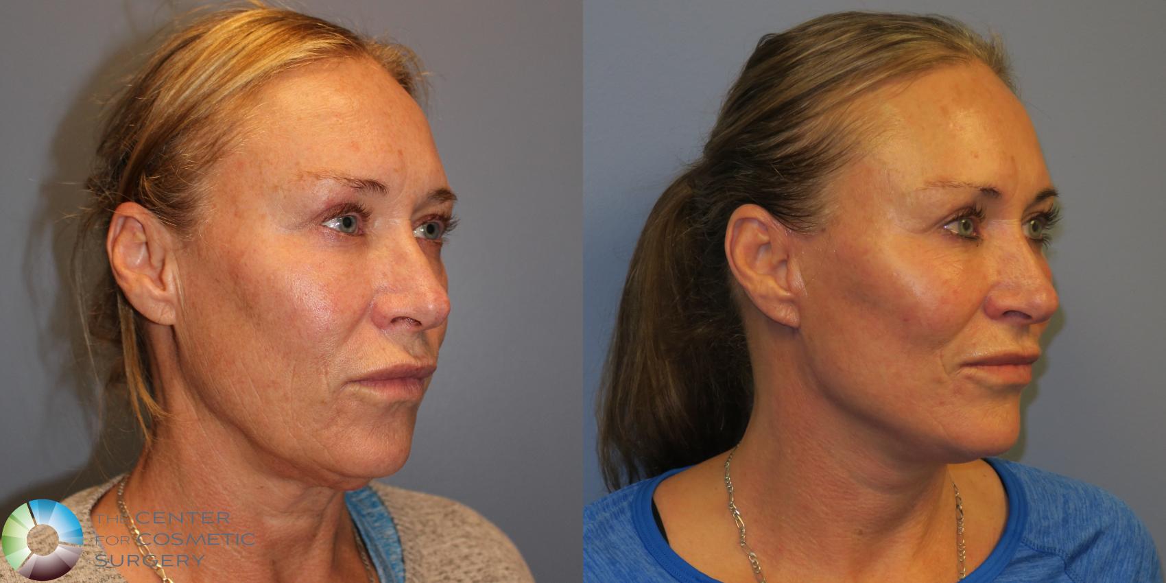 Before & After Mini Facelift Case 11293 Right Oblique View in Golden, CO