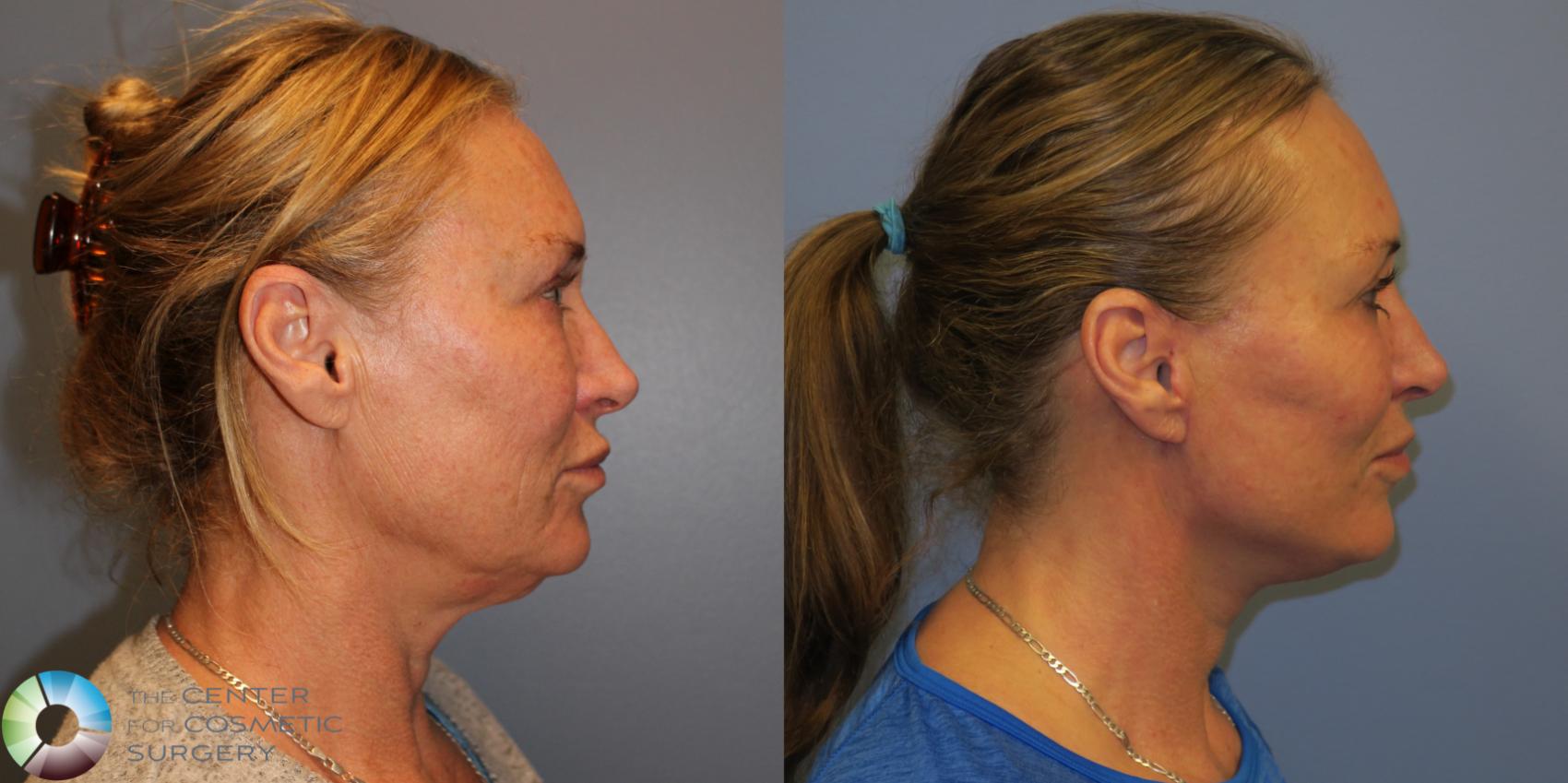 Before & After Mini Facelift Case 11293 Right Side View in Golden, CO