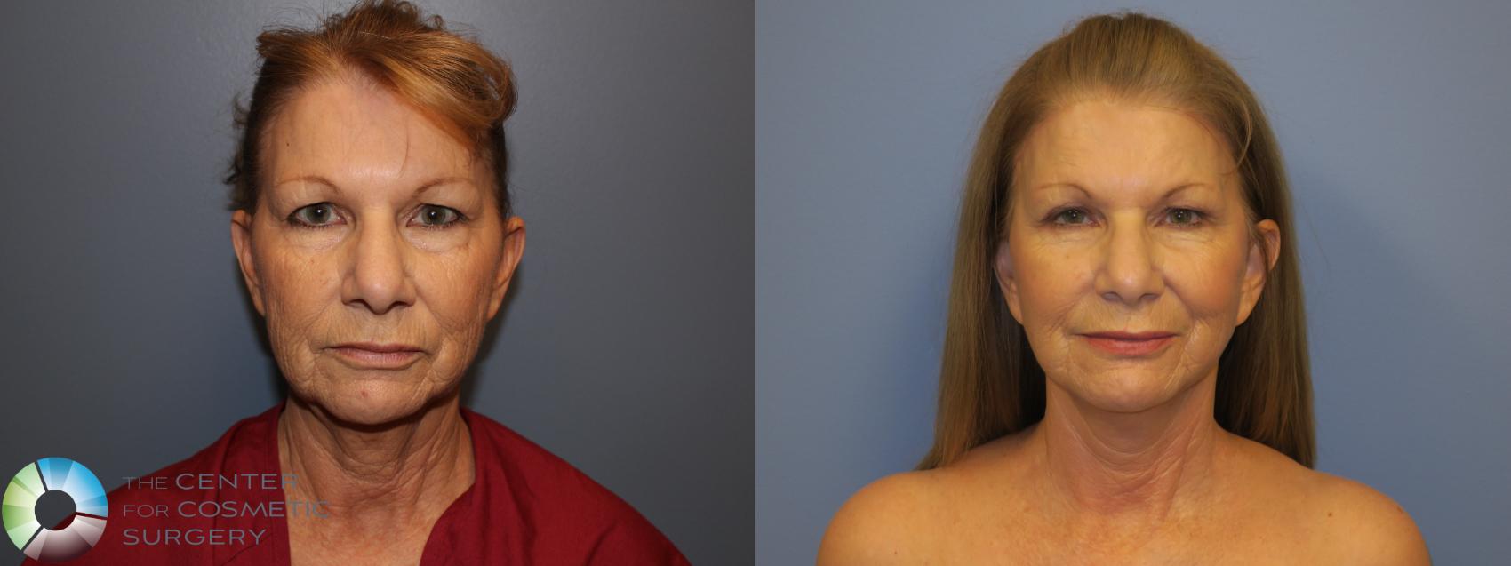 Before & After Mini Facelift Case 11296 Front View in Golden, CO