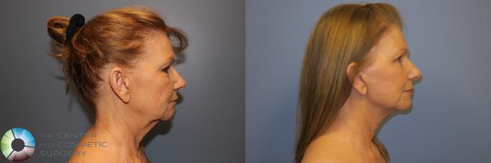 Before & After Mini Facelift Case 11296 Right Side View in Golden, CO