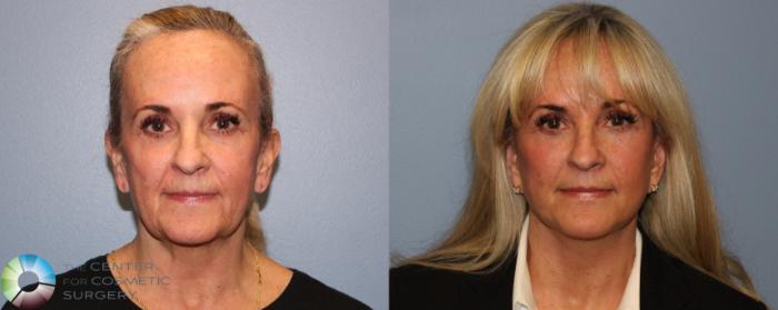 Before & After Mini Facelift Case 11297 Front View in Golden, CO